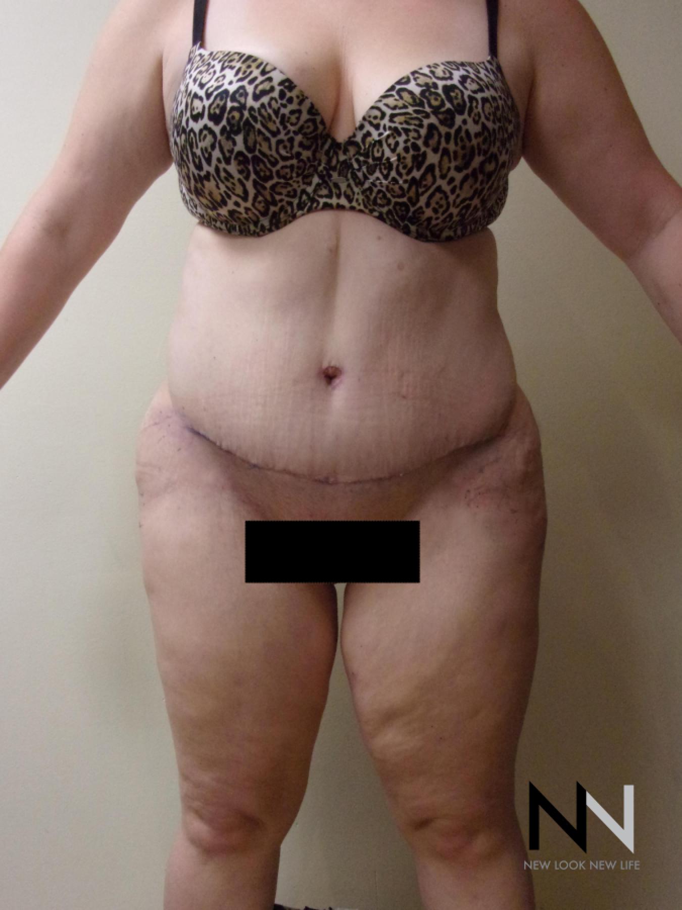 Abdominoplasty: Patient 1 - After 1