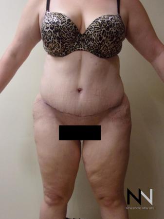 Abdominoplasty: Patient 1 - After Image 1