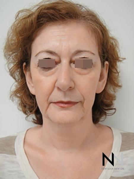 Liquid Facelift: Patient 2 - Before 1