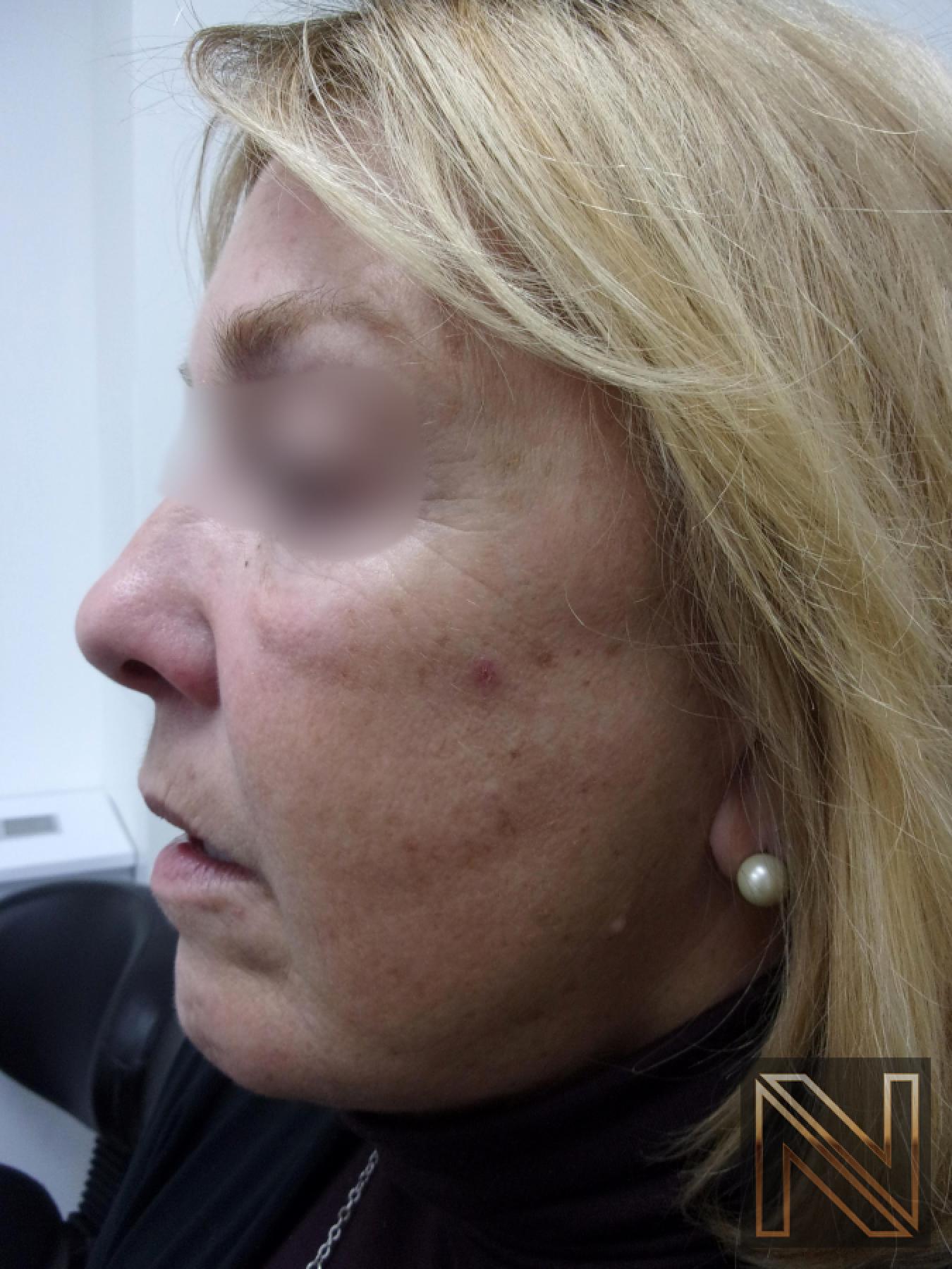 Laser Skin Resurfacing - Face: Patient 1 - Before and After 2