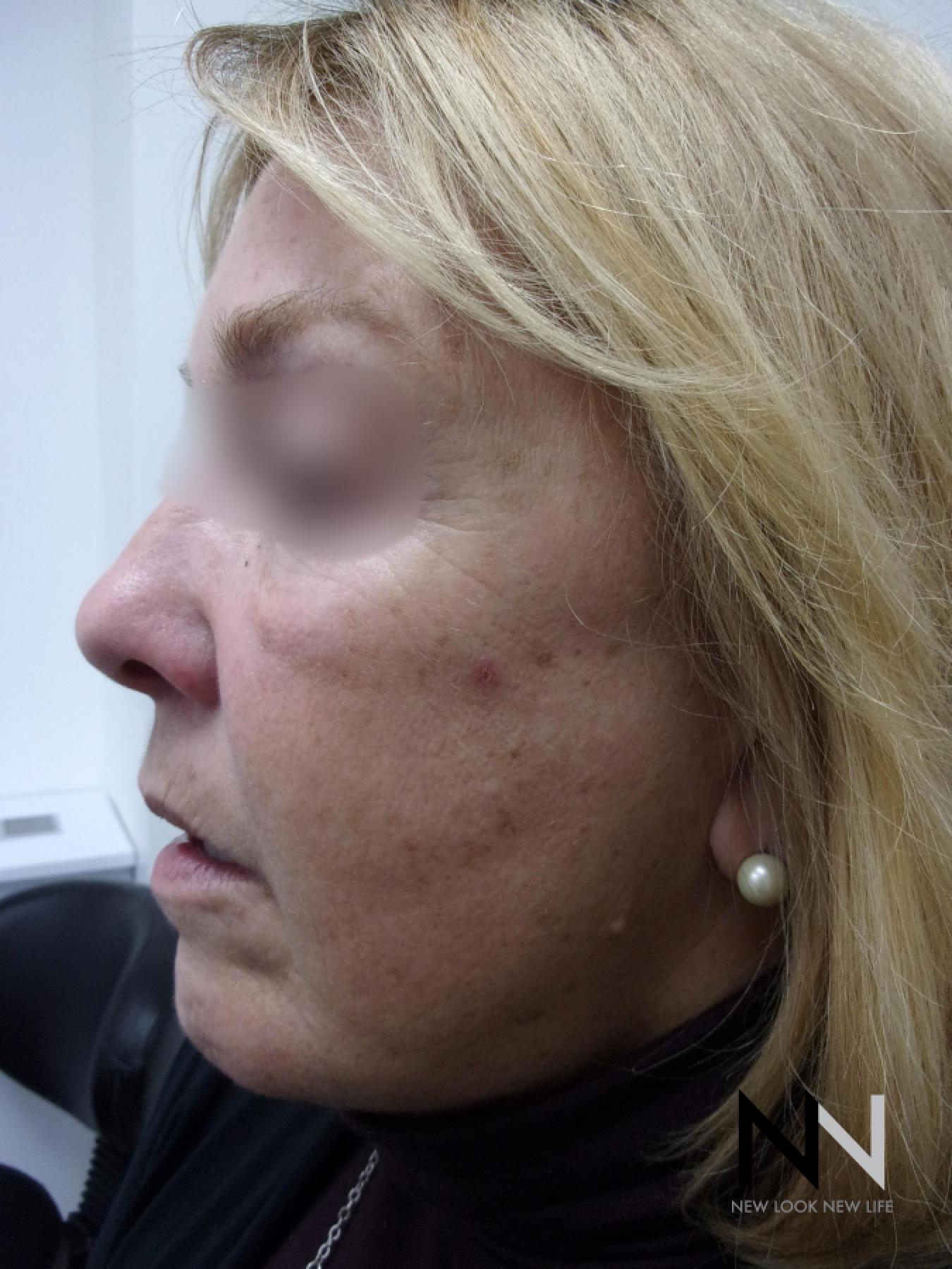 Laser Skin Resurfacing - Face: Patient 1 - Before and After 2