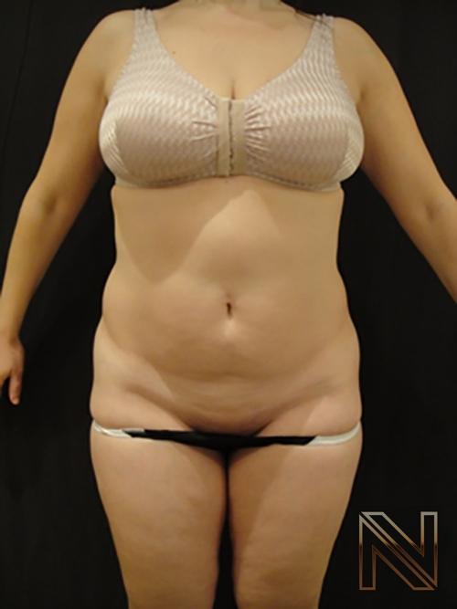 Liposuction: Patient 5 - Before 