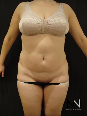 Liposuction: Patient 5 - Before Image 1