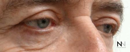 Blepharoplasty: Patient 7 - After Image 2
