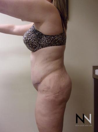 Abdominoplasty: Patient 1 - After Image 2