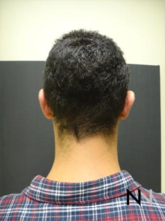 Otoplasty And Earlobe Repair: Patient 4 - After Image 1