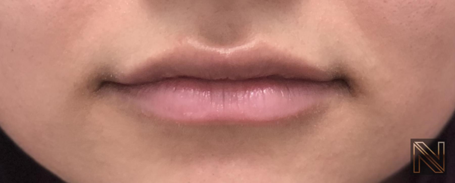 Fillers: Patient 8 - After 1