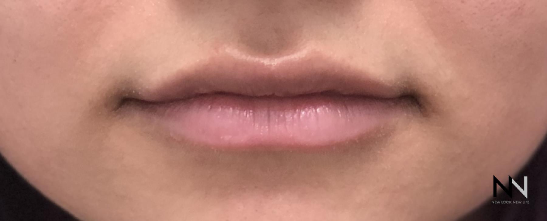 Fillers: Patient 8 - After  