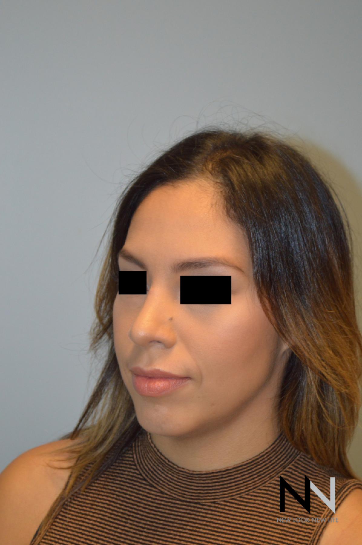 Rhinoplasty: Patient 6 - After 4