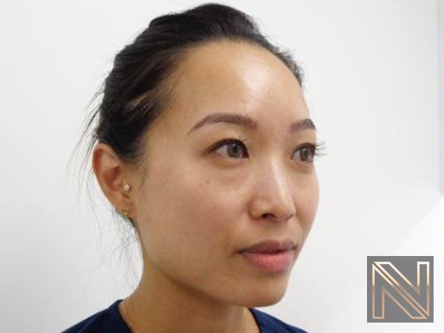 Laser Skin Resurfacing - Face: Patient 5 - After 2