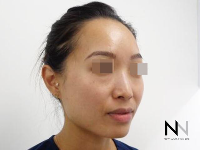 Laser Skin Resurfacing - Face: Patient 5 - After 2