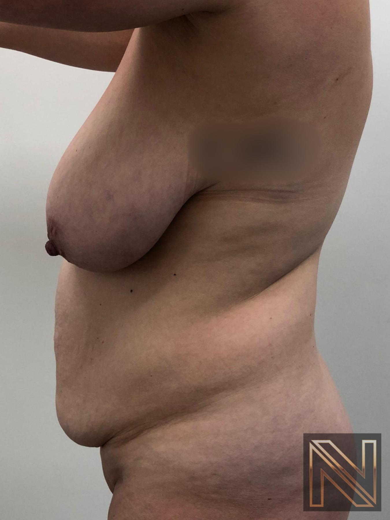 Abdominoplasty: Patient 28 - Before 2