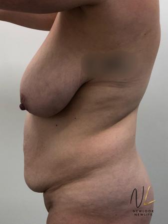Abdominoplasty: Patient 28 - Before 2