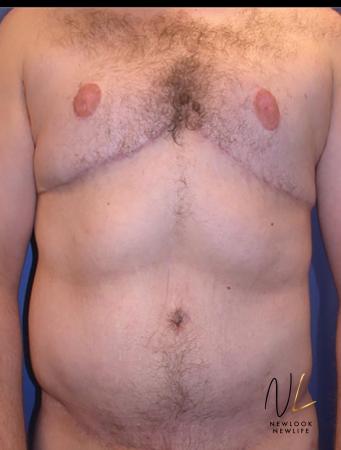 Abdominoplasty: Patient 32 - After 1