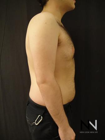 Gynecomastia: Patient 5 - After Image 4