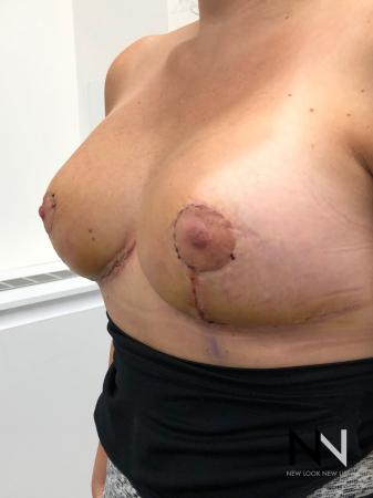 Breast Lift: Patient 8 - After Image 2