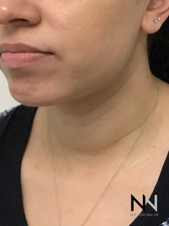 Liposuction: Patient 2 - After Image 3