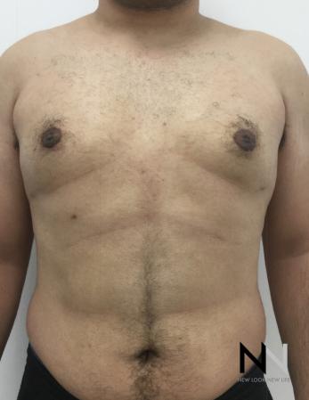 Gynecomastia: Patient 10 - After Image 1