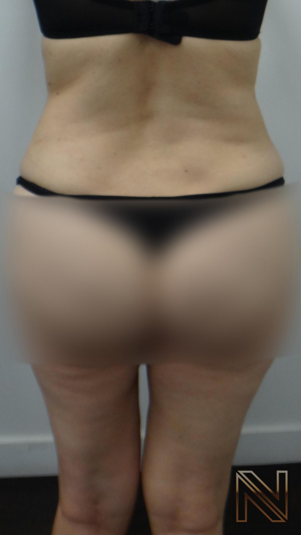 Liposuction: Patient 12 - After 2