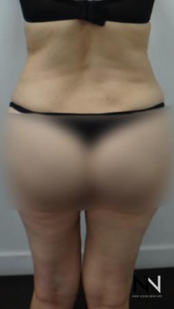 Liposuction: Patient 12 - After Image 2