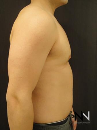 Gynecomastia: Patient 3 - After Image 5
