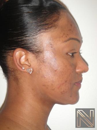 Laser Skin Resurfacing - Face: Patient 4 - Before 2