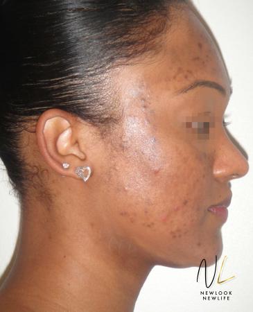 Laser Skin Resurfacing - Face: Patient 4 - Before Image 2