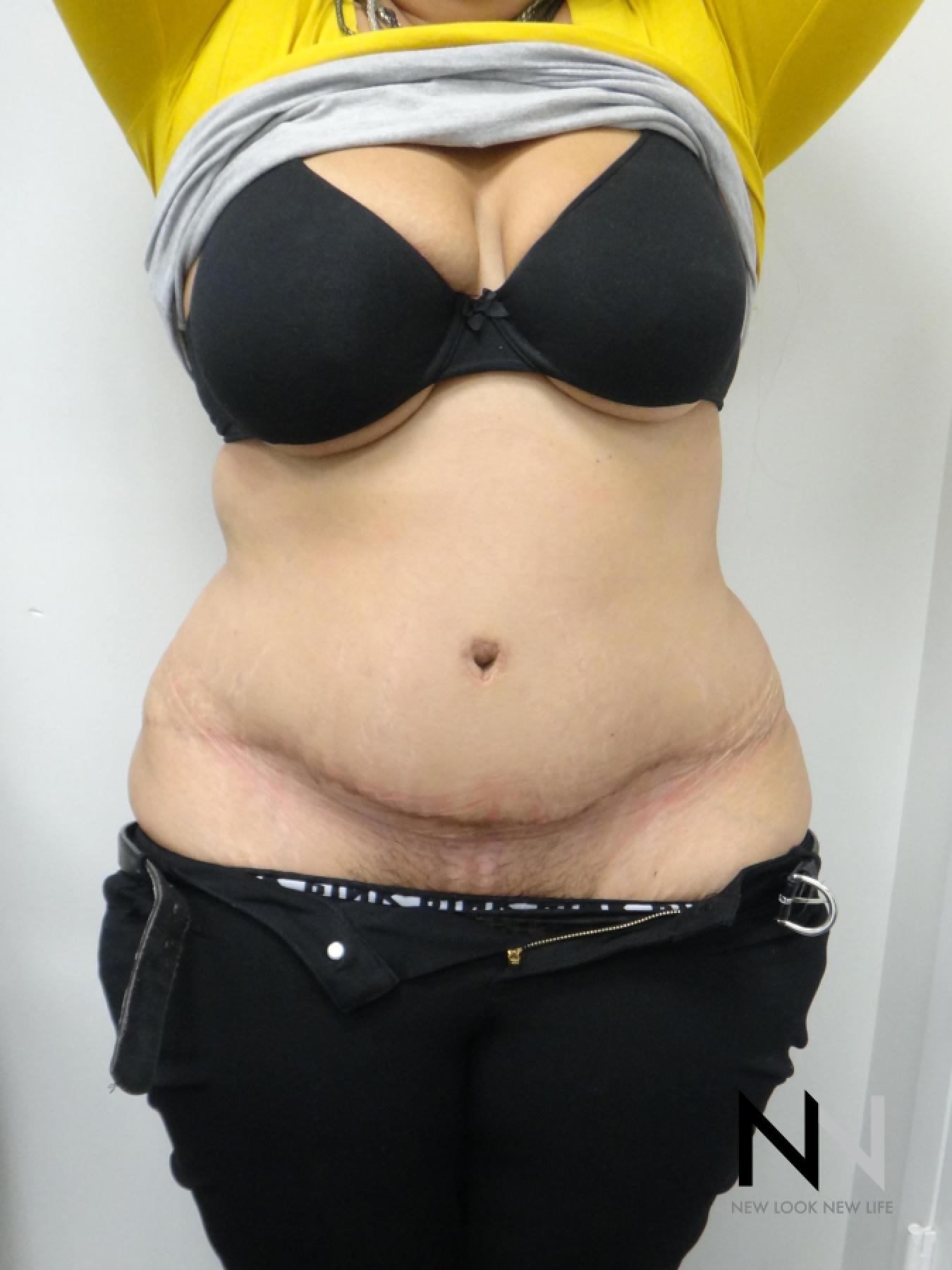 Abdominoplasty: Patient 26 - After 1