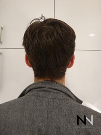 Otoplasty And Earlobe Repair: Patient 1 - After Image 1