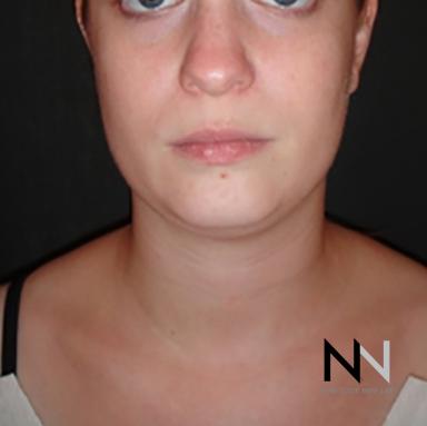 Liposuction: Patient 1 - Before Image 1
