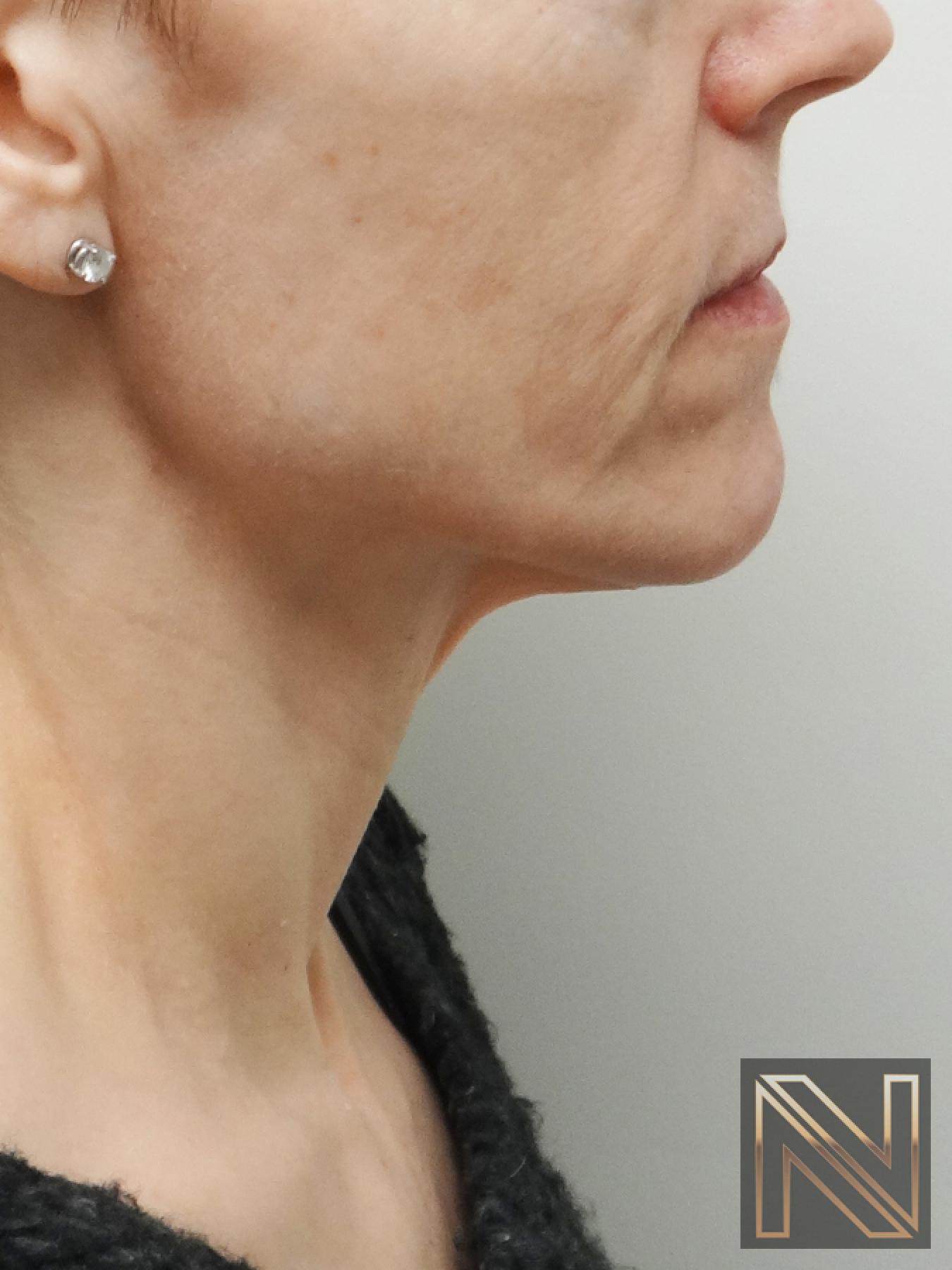Ultherapy®: Patient 1 - Before and After 2