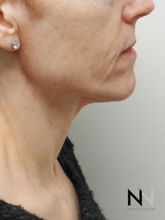Ultherapy®: Patient 1 - Before and After 2