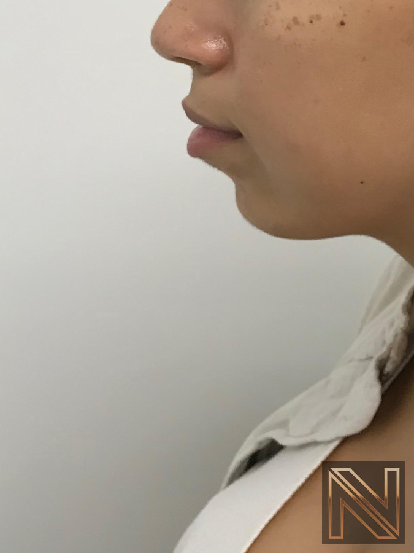 Chin Augmentation: Patient 1 - After 2