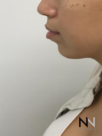 Chin Augmentation: Patient 1 - After Image 2