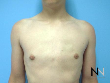 Gynecomastia: Patient 8 - After Image 1