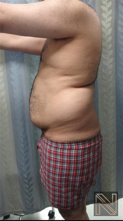 Liposuction: Patient 16 - Before 2