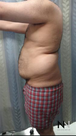 Liposuction: Patient 16 - Before Image 2