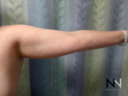Liposuction: Patient 24 - Before Image 3
