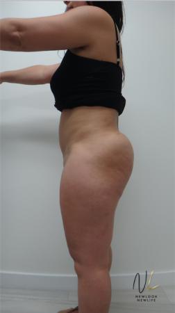 Liposuction: Patient 15 - After Image 3
