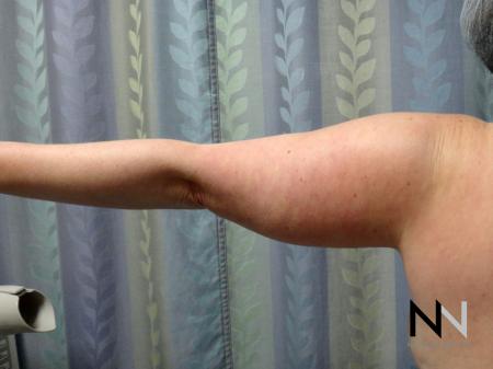 Liposuction: Patient 24 - Before Image 1