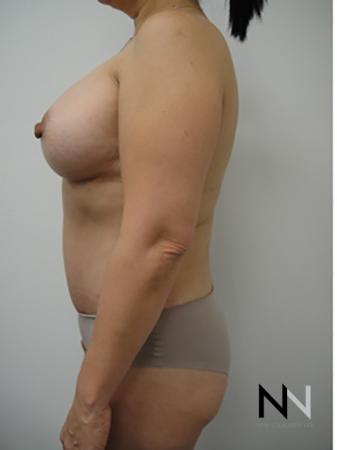 Abdominoplasty: Patient 6 - After Image 2