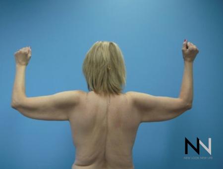 Brachioplasty: Patient 5 - Before 1