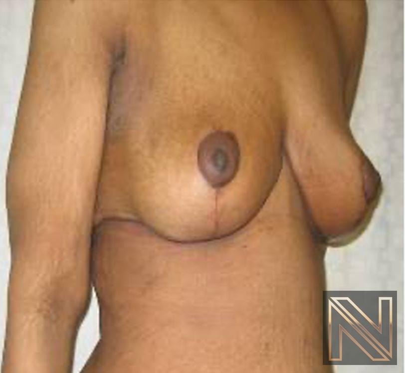 Breast Lift: Patient 13 - After 2