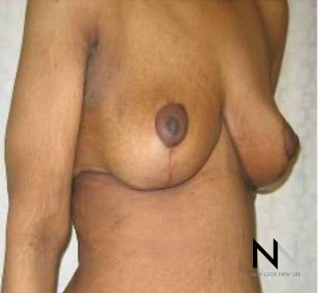 Breast Lift: Patient 13 - After Image 2