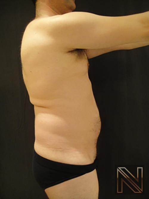 Liposuction: Patient 17 - Before 2