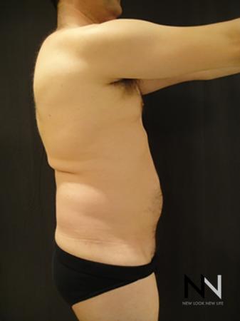 Liposuction: Patient 17 - Before Image 2
