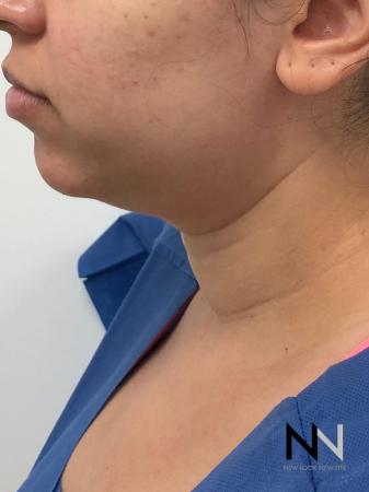 Liposuction: Patient 2 - Before and After Image 4