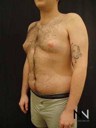 Gynecomastia: Patient 5 - Before Image 2