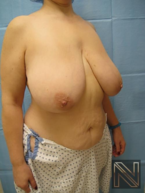 Breast Reduction: Patient 8 - Before 3