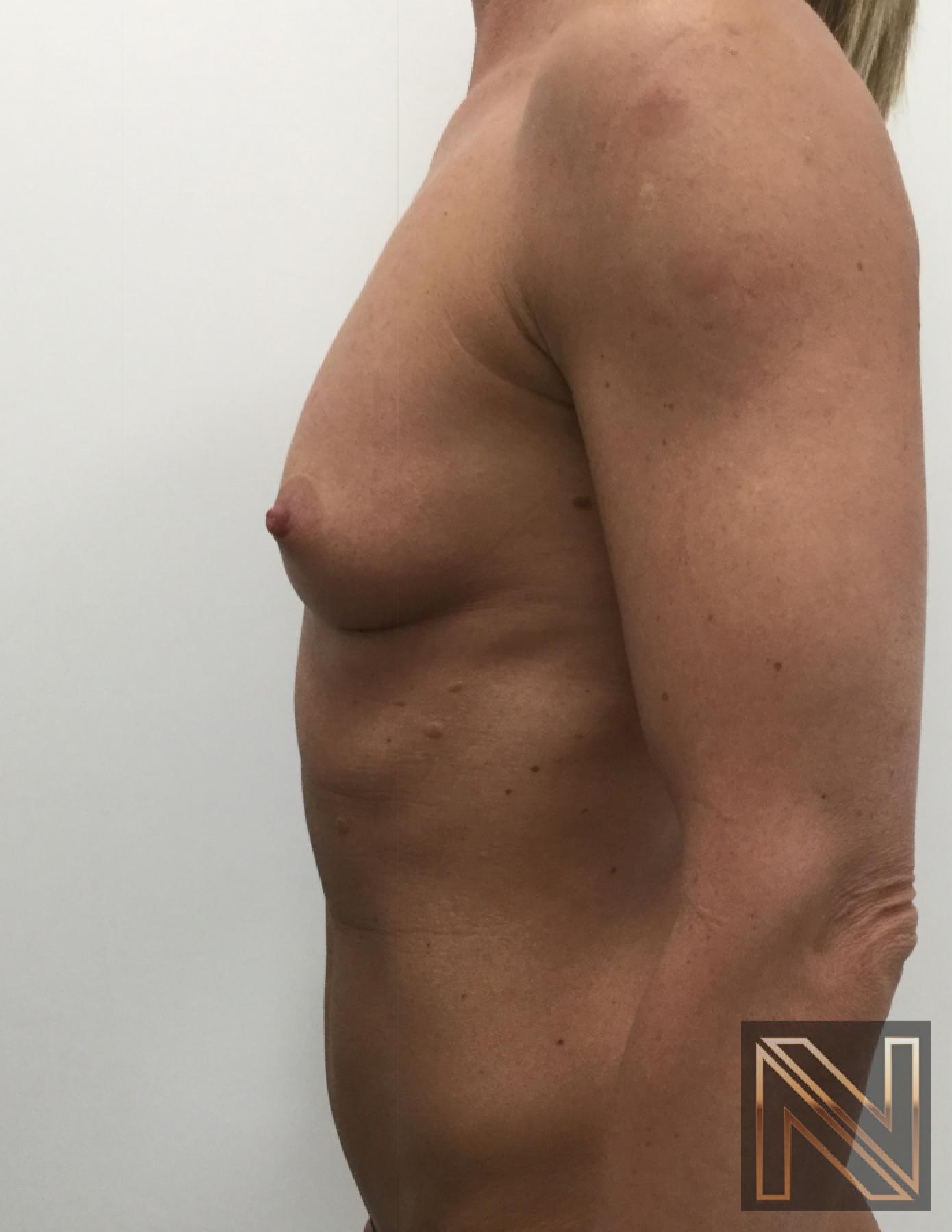 Breast Augmentation: Patient 3 - Before 2